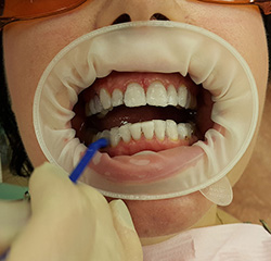 завершающий этап отбеливания зубов