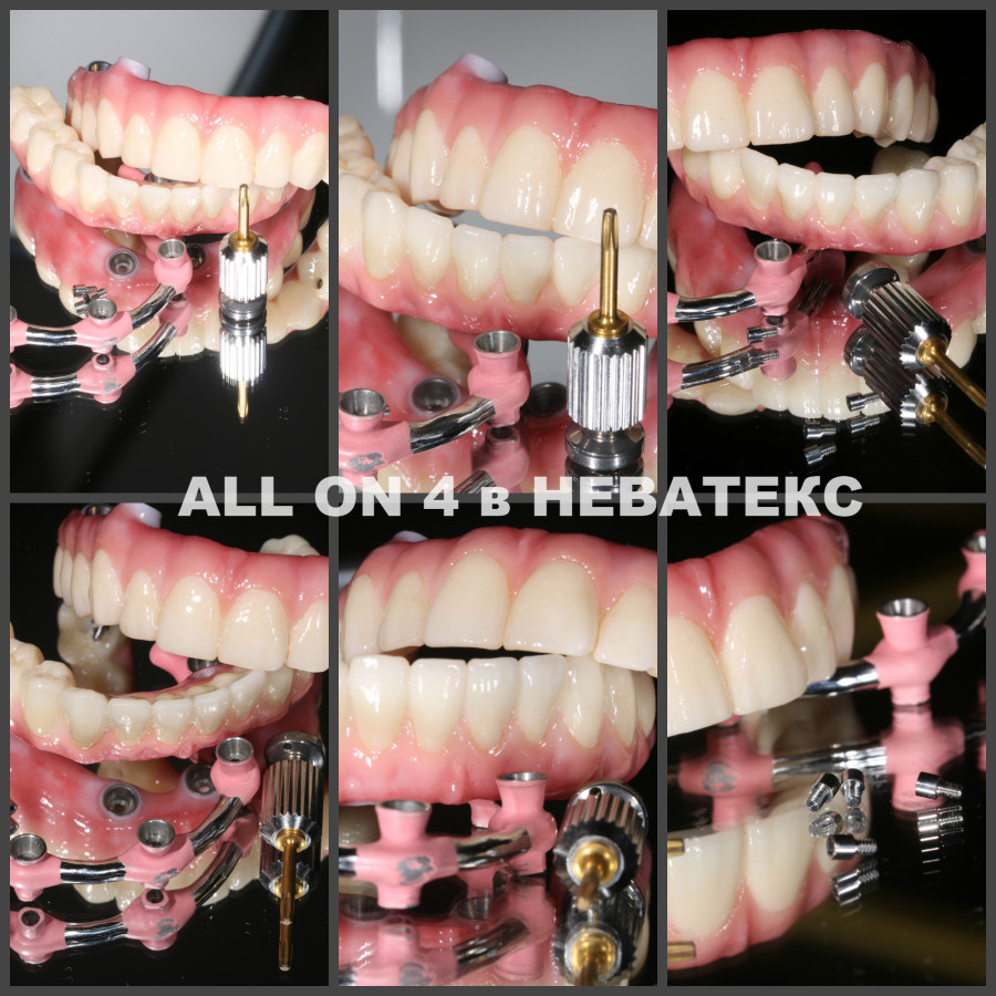 all on 4 фото постоянных протезов all on 4 фото постоянных протезов циркон