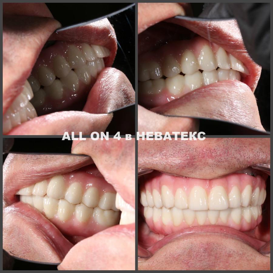 all on 4 фото постоянных протезов all on 4 фото протезов циркон