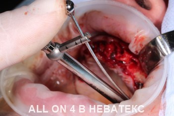 операция имплантация all on 4 операция имплантация all on 4