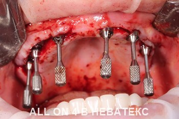 имплантация allon4 имплантация allon4