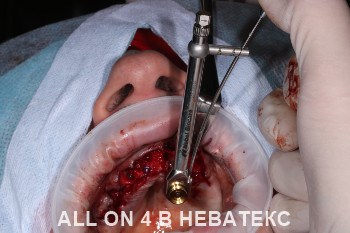 имплантация all-on-4 имплантация all-on-4