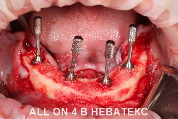 имплантация all-on-4 фото нижней челюсти имплантация all-on-4 фото нижней челюсти