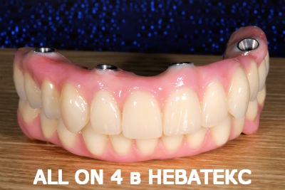 allon4 имплантация allon4 имплантация