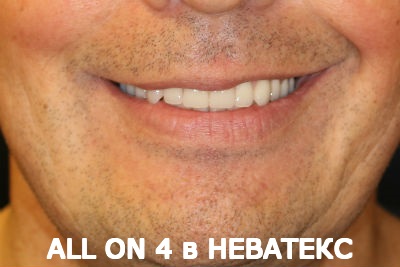 allon4 несъемные зубные протезы allon4 несъемные зубные протезы