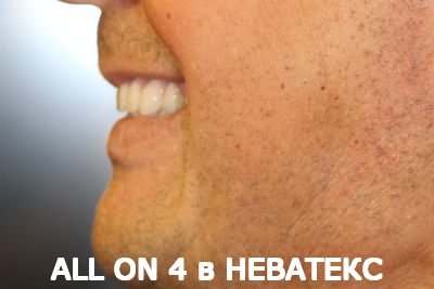 all on 4 несъемные протезы вид сбоку all on 4 несъемные протезы вид сбоку