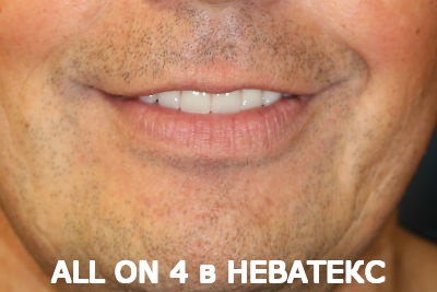 all on 4 вид спереди в неватекс all on 4 вид спереди