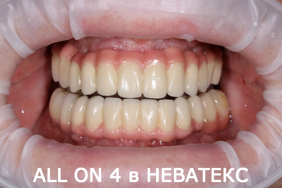 Технология Все зубы на шести имплантах все зубы на шести имплантах