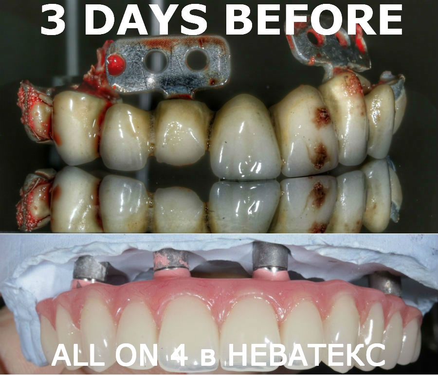 состояние челюсти до имплантации all on 4 фото состояние челюсти до имплантации all on 4