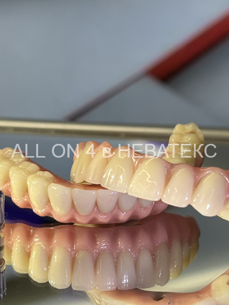 вид верхней челюсти all on 4 постоянные протезы all on 4