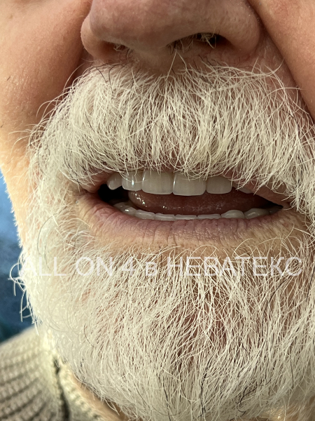 верхняя челюсти олл он фо протезы all-on-4 предназначены для постоянного ношения