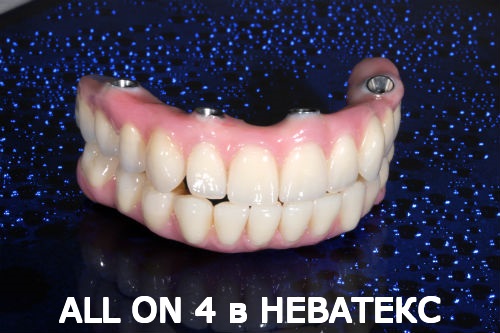 all on 4 фото несъемных протезов Неватекс Москва all on 4 фото несъемных протезов