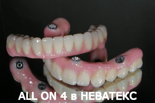 как выглядят протезы allon4 как выглядят протезы allon4