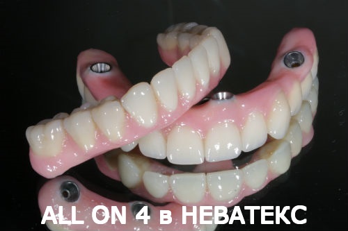 allon4 протезы верхняя и нижняя челюсти неватекс allon4 протезы верхняя и нижняя челюсти