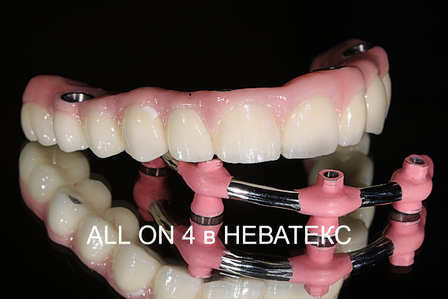 фото зубов all on 4 с имплантами фото зубов all on 4