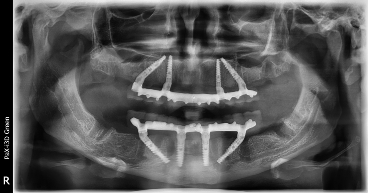 Как выглядит имплантация All on 4 all on 4 имплантация рентгеновский снимок