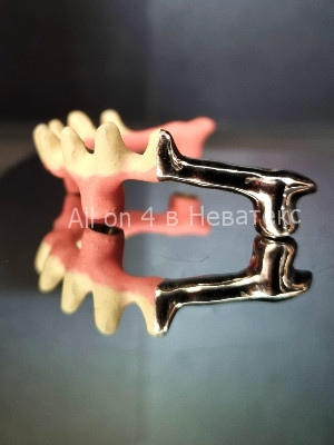 состояние челюсти до имплантации all on 4 дуга-гребенка для протеза all on 4