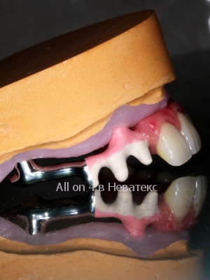 состояние челюсти до имплантации all on 4 дуга-гребенка для протеза all on 4