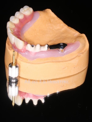 улыбка после имплантации алл он фо балка - основа керамокомпозитного протеза