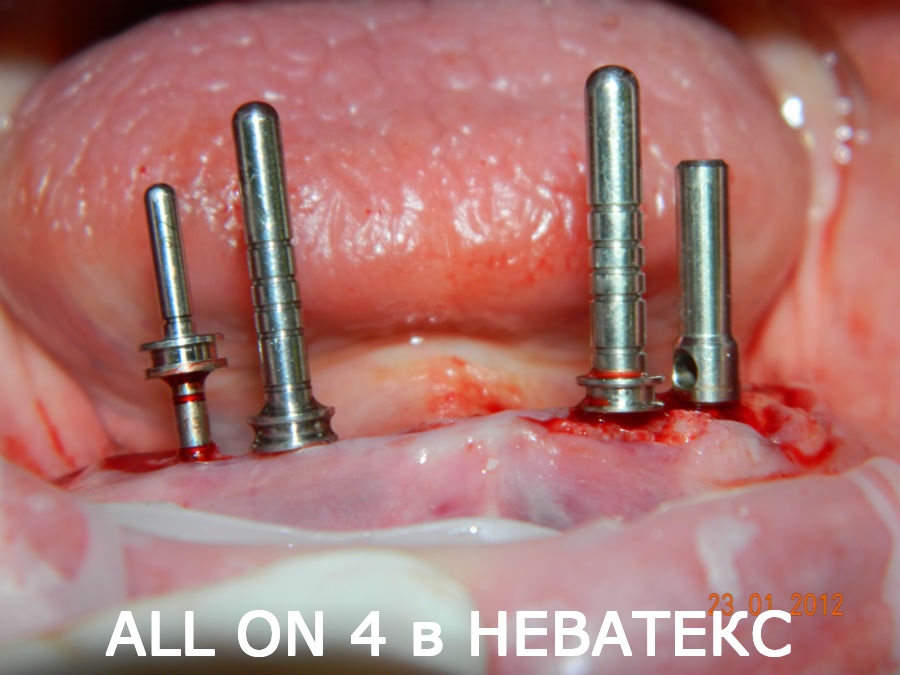 Зубы за один день. В процессе операции All on 4 зубы за один день all on 4