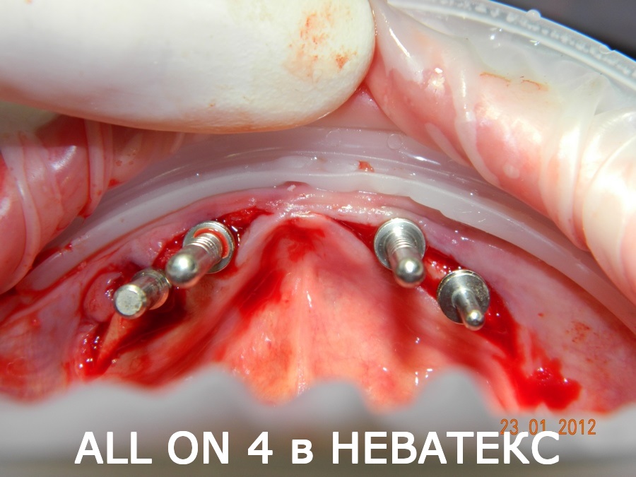 Установка новых зубов за 1 день по технологии All on 4 зубы за 1 день по техногии all on 4