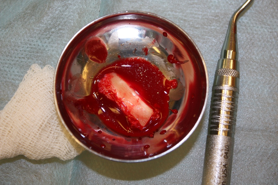 костный блок алл он фо