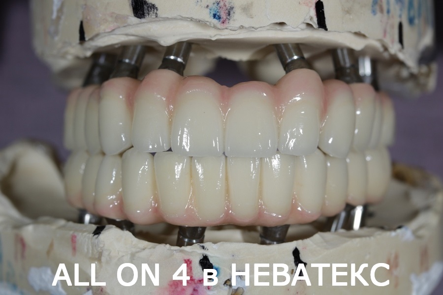 Восстановление отсутствующих зубов в клинике Неватекс all on 6 неватекс