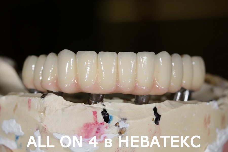 Возвращаем зубы All on 6 all on 6 имплантмен