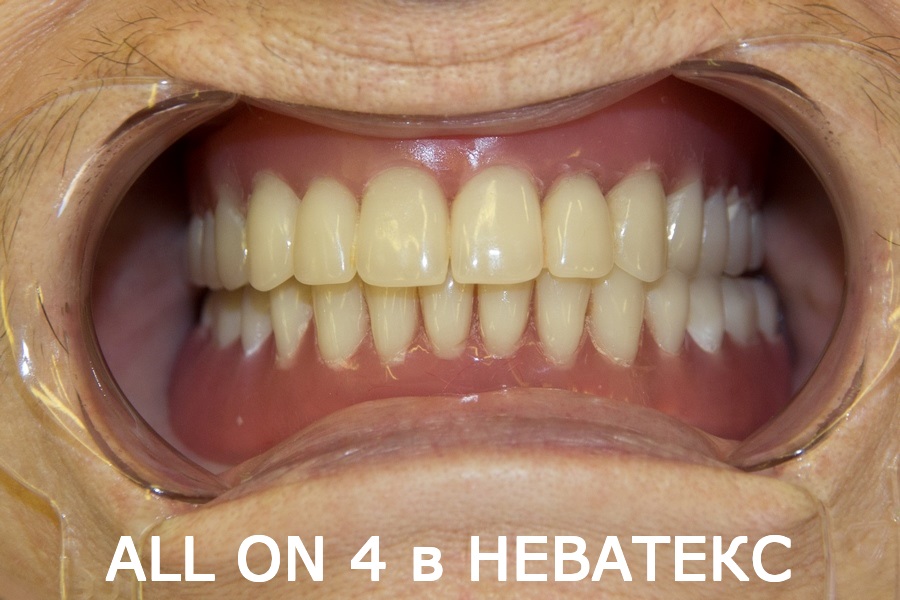 Зубы за один день - картинки идеальной улыбки зубы за один день картинки