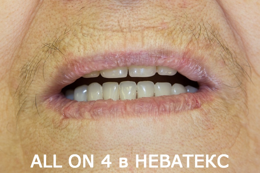 Зубы за один день - фото сразу после установки зубы за один день фото до и после