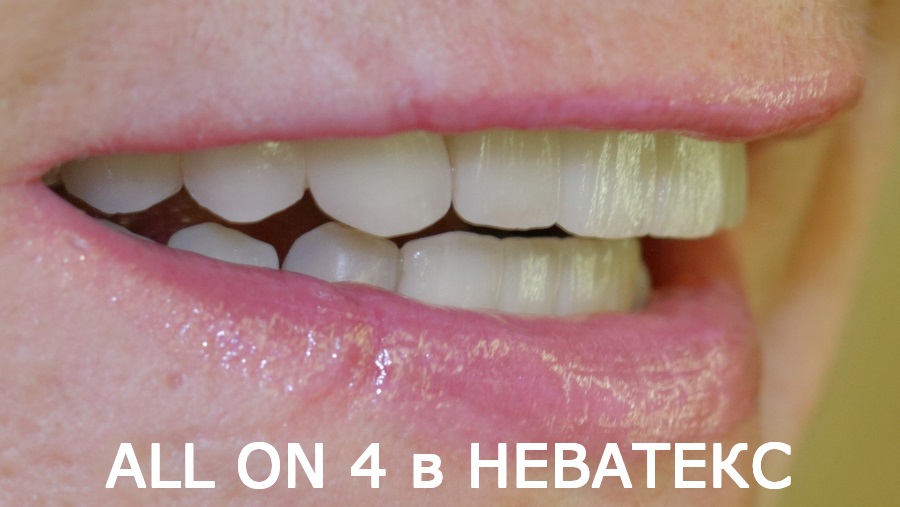 Верхняя и нижняя челюсти после установки системы на 4 имплантах челюсть на 4 имплантах до и после